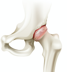 股関節の骨の形状と変形性股関節症について Hero S Body