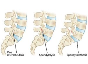 脊柱分離症及び脊柱すべり症