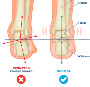 足部のプロネーション