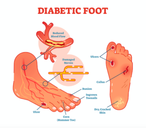糖尿病の足