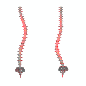 脊柱側彎症のカーブの種類