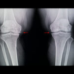 変形性膝関節症