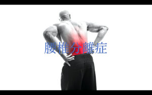 腰椎分離症