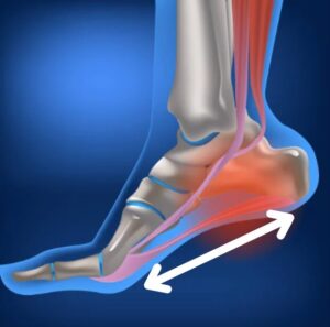 フォアフット着地と足底筋膜炎
