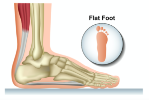 扁平足の解剖学