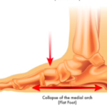 足のアーチの崩れ扁平足