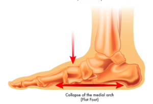 足のアーチの崩れ扁平足